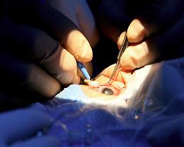 Cataratta, boom di interventi