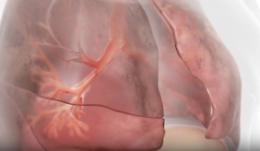 Innovazioni terapeutiche nella BPCO con enfisema