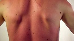 Tumori cutanei non melanoma, ecco cosa sono. E occhio all'esposizione al sole