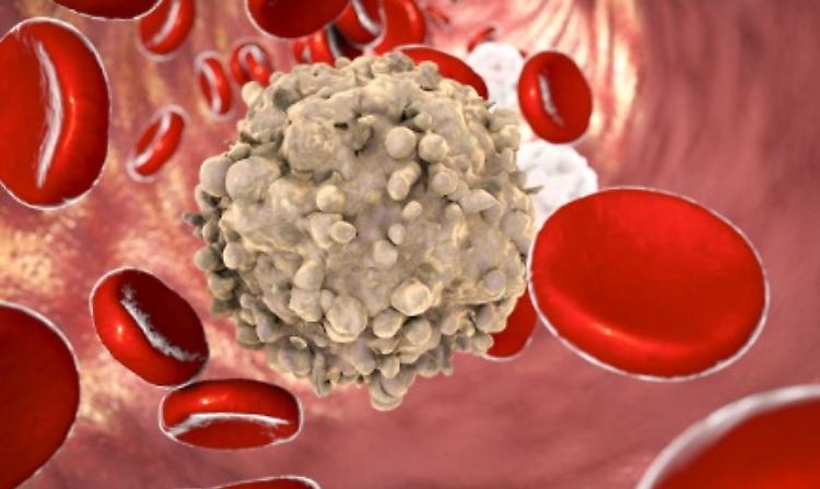 Leucemia, con cellule laboratorio scomparsa in 86% malati
