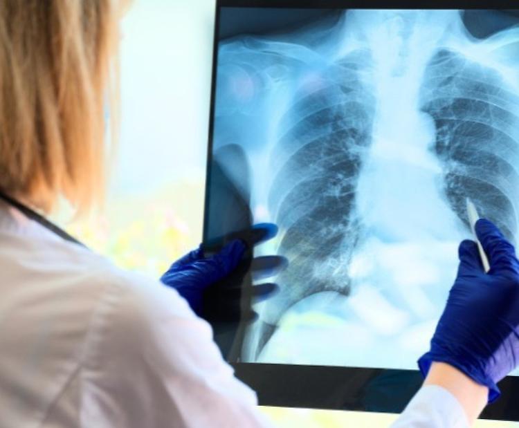 Tumore al polmone, uno screening salvavita